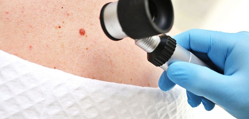 Ocena zmian barwnikowych skóry – znaczenie obserwacji i diagnostyki