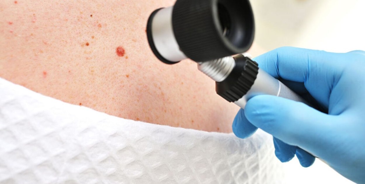 Ocena zmian barwnikowych skóry – znaczenie obserwacji i diagnostyki